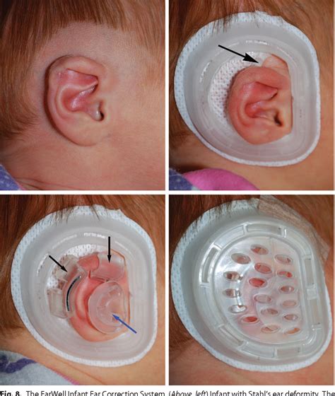 Products Earwell® Infant Ear Correction System