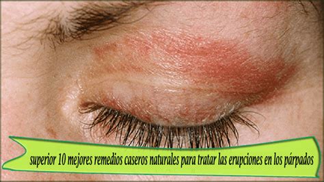 Dermatitis En Los Parpados Remedios Caseros Chopidea
