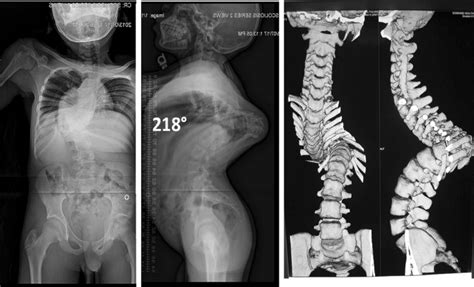 A Novel Radiographic Classification Of Severe Spinal Curvatures
