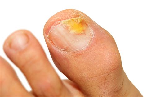 Fungal Foot Infections - The Institute of Chiropodists and Podiatrists