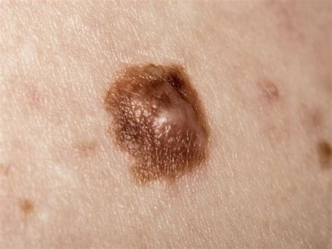 What Does Stage 1 Skin Cancer Look Like CancerWalls