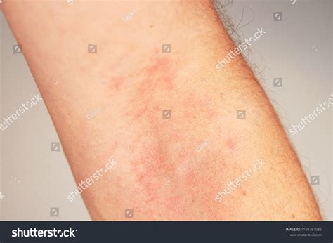 Mild Atopic Dermatitis Arms