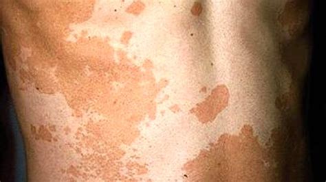 💉 Weiße Flecken Auf Der Haut Was Verursacht Es Dein Arzt 2020