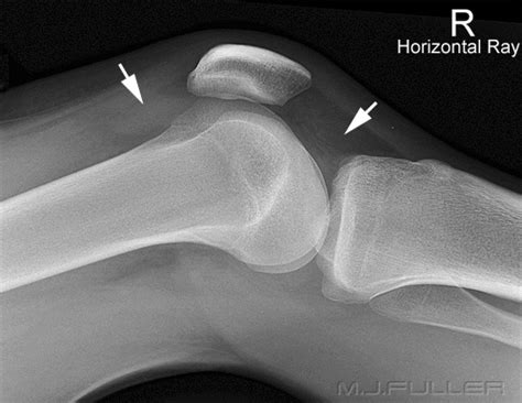 Soft Tissue Signs Knee Trauma WikiRadiography