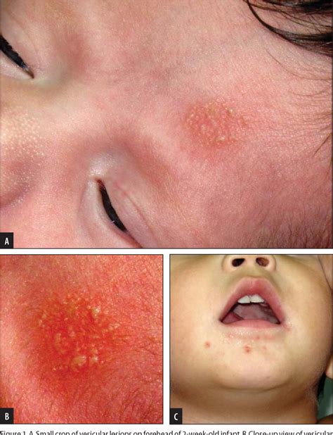 Figure 1 From Diagnostic Dilemmas Of A Herpes Like Rash In Healthy