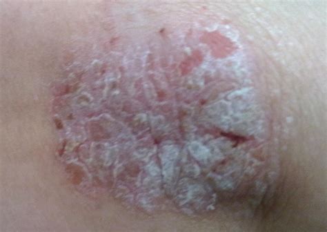 Raised Scaly Bump On Skin