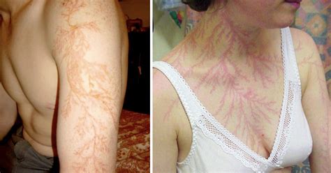 People Who Survived Getting Struck By Lightning Show What It Does To Your Skin Gag
