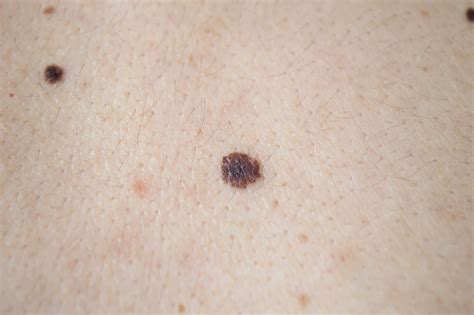 Skin Cancer Moles On Arms