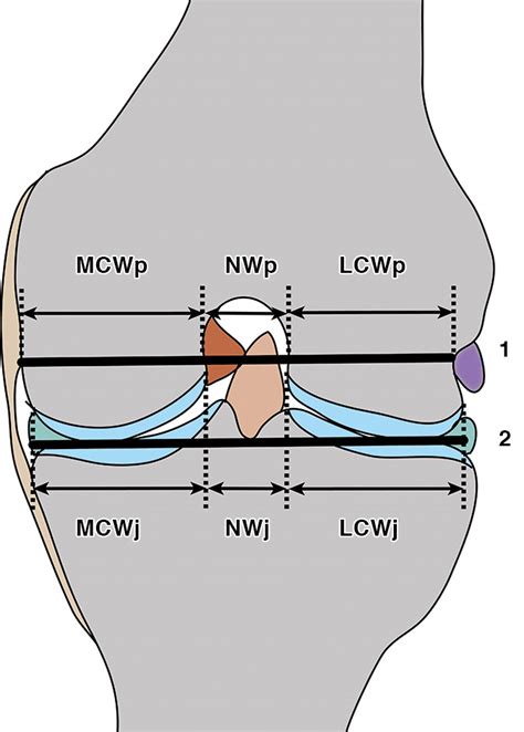 The Femoral Intercondylar Notch During Life An Anatomic Redefinition