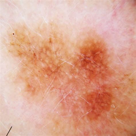 Skin Cancer Melanoma Signs And Symptoms Skin Cancer Images And