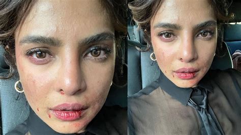 Priyanka Chopra Shares Pic Of Bruised Face Leaves Fans Concerned Bollywood Hindustan Times