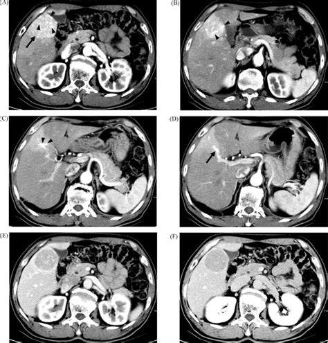 Assessment Of Triple Phase Ct Findings For The Differentiation Of Fat