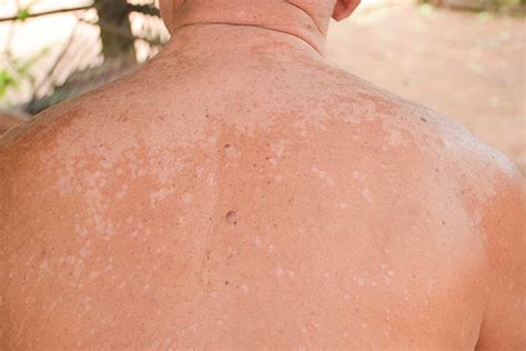 Tinea versicolor is a common fungal infection of the skin. White Spots On A Child's Face: Causes, Remedies & Treatment