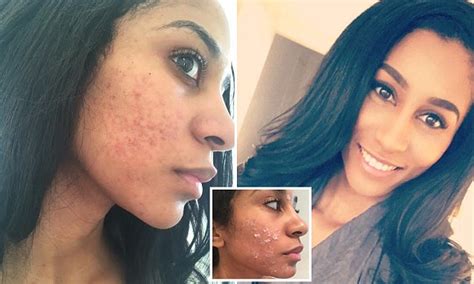 Shop Assistant Left With Horrific Rash After Face Waxing Daily Mail