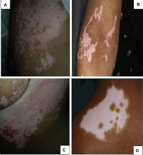 Phototherapy And Combination Therapies For Vitiligo Dermatologic Clinics
