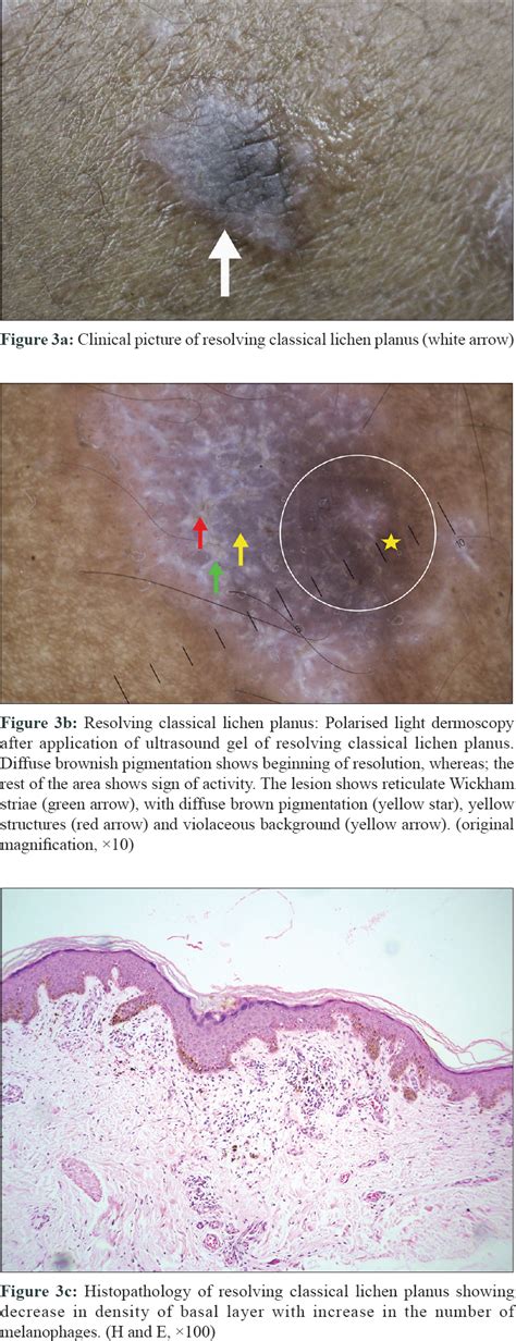 dermoscopic features of various stages of lichen planus indian journal of dermatology