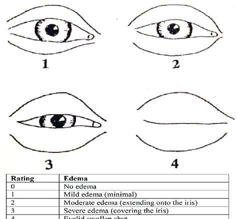 Severity Scoring System For Edema Around The Eye Download Scientific