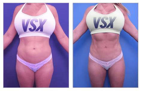 tummy tuck with abdominal etching - Cosmetic Surgery Tips