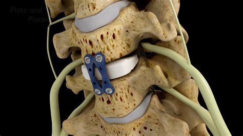 Anterior Cervical Discectomy And Fusion Is A Surgical Procedure To