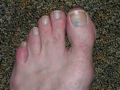 Dark spots on toenails is an unpleasant condition, which is basically caused by the moisture which gets trapped in the nails. Legs & Wings: Webbed Toe Photos (a real ratings booster)