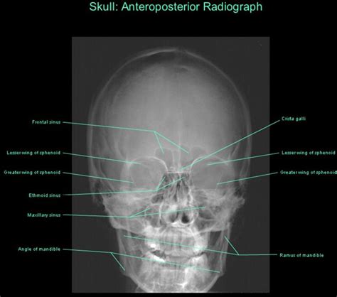 Frontal Radiograph Of Skull Medical Radiography Anatomy Images Anatomy