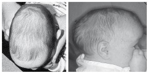 Modern Treatment Of Scaphocephaly Experience Based On 120 Cases Snpcar