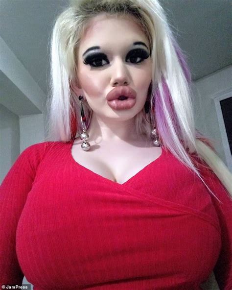 Woman 22 Who Has Spent Thousands Quadrupling The Size Of Her Lips Undergoes Her 20th Injection
