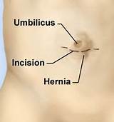 Pictures of How Long Is Recovery After Umbilical Hernia Surgery