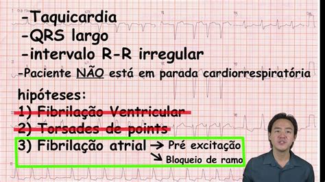Eletrocardiograma análise fibrilação atrial com bloqueio de ramo YouTube