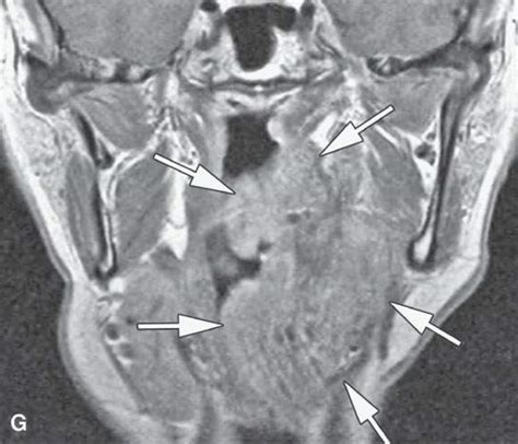 Oropharynx Benign Noninflammatory Masses And Tumors Radiology Key