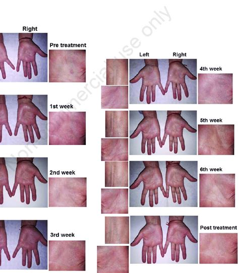 Progression Of The Areas With Non Atopic Dermatitis In The Hands