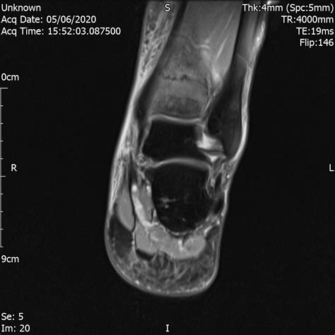 Undisplaced Fracture Distal Tibial Metaphysis Cases Home