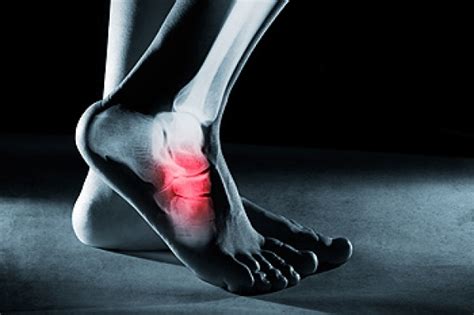 What Is A Navicular Stress Fracture