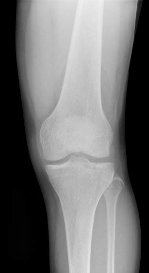 Digital Xray Of The Knee Showing A Tibial Plateau Fracture Stock Photo