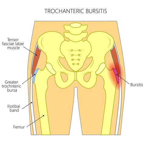 Hip Bursitis Pro Motion Physiotherapy Thornhill