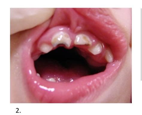 Dental Management Of The Child Dental Patient With Cerebral Palsy Rjd