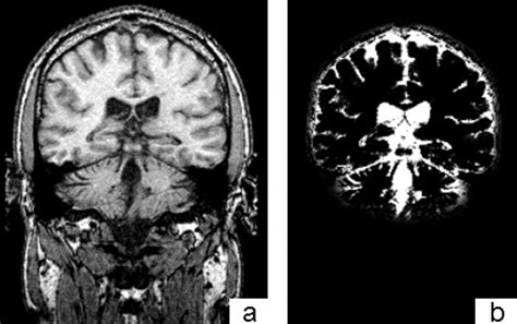 Whole Brain Atrophy In Multiple Sclerosis Measured By Automated Versus
