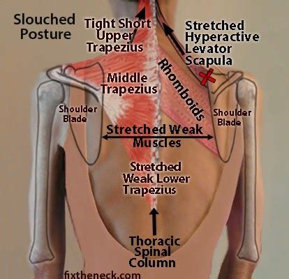 Pain experienced in specific points between your shoulder blades. Reclaim Your Life: When Sitting is a Pain in the Neck