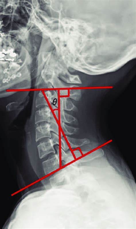 A Lateral Cervical X Ray In The Neutral Position Showing A Cobb Angle