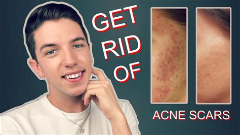 How To Get Rid Of Acne Scars Once And For All News For Real Rebels