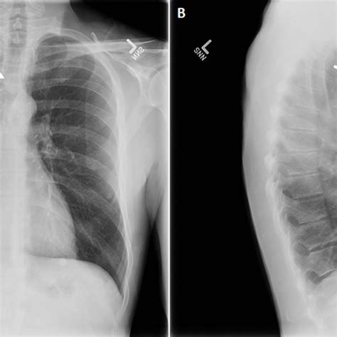 Chest X Ray A Anterior Posterior And B Lateral Showing Rounded