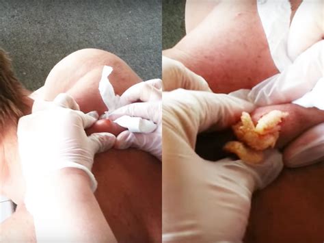 Keep an eye out for the following signs step 2. Watch A 30-Year-Old Cyst Get Popped And Prepare To Be ...