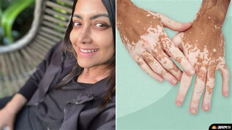 What Is Vitiligo South Actress Mamta Mohandas Diagnosed With This