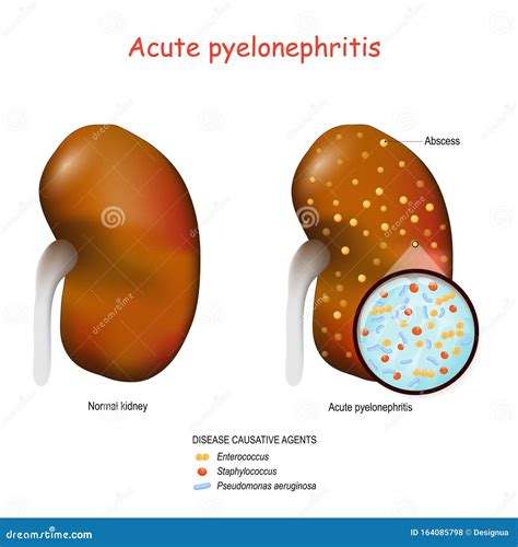 Pathophysiology Of Pyelonephritis