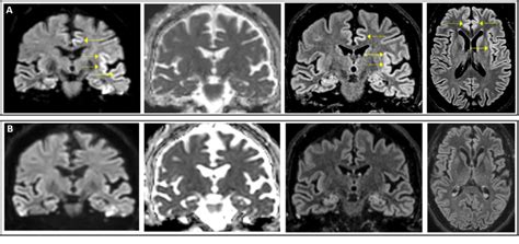 Representative Mri Images Showing Coronal Dwi Adc And Flair Sequences