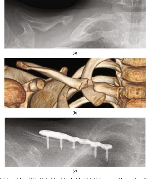 Figure 1 From Use Of A Free Vascularized Medial Femoral Condyle Flap