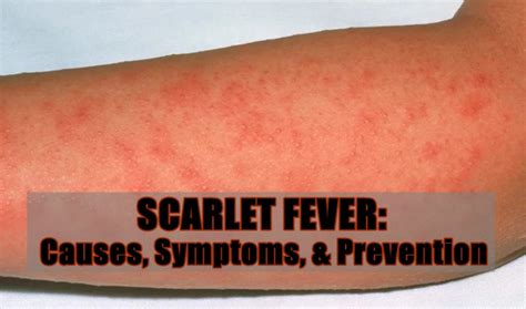 Scarlet Fever Causes Symptoms Prevention