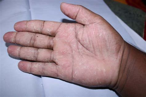 Palmoplantar Psoriasis Symptoms Triggers And Treatment