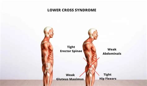 Lower Cross Syndrome Symptoms And Treatment