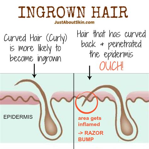Ingrown Hair Pubic Pictures Ingrown Hair Prevention And Treatment